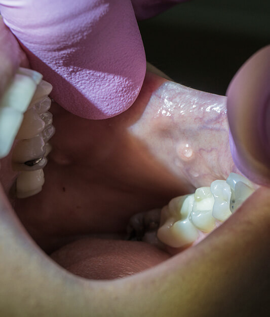 Symptoms of Gland Tumors & Parotid Cancer